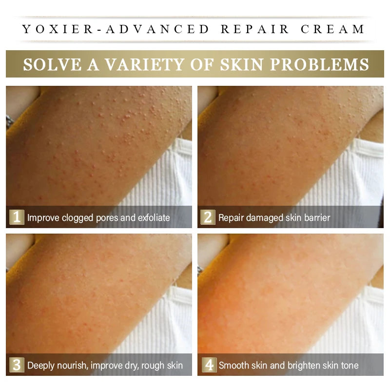 Remove Keratosis Pilaris Repair Cream Improve Skin Defects Impurities Roughness Dryness Moisturizing Body Care Vitamin E 50g